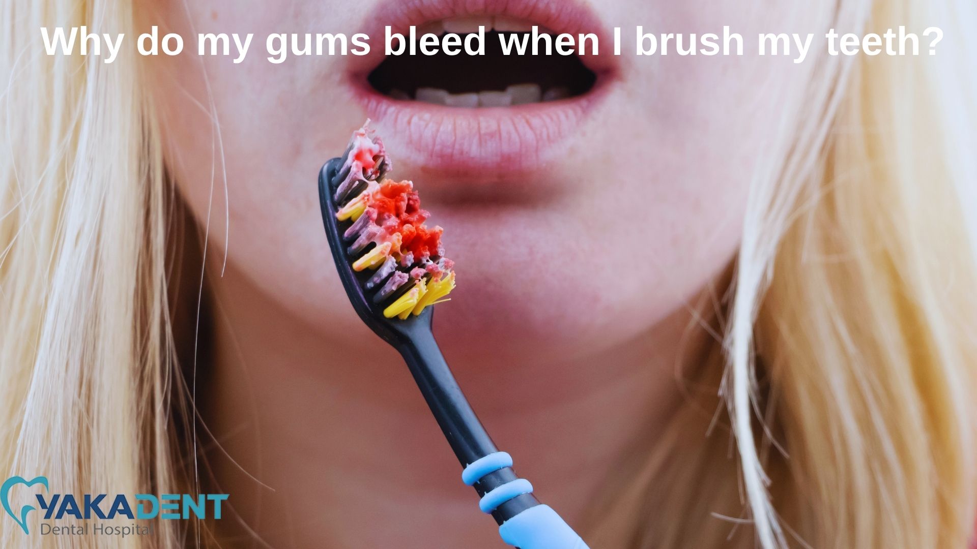Bleeding gums: Why do my gums bleed when I brush my teeth?
