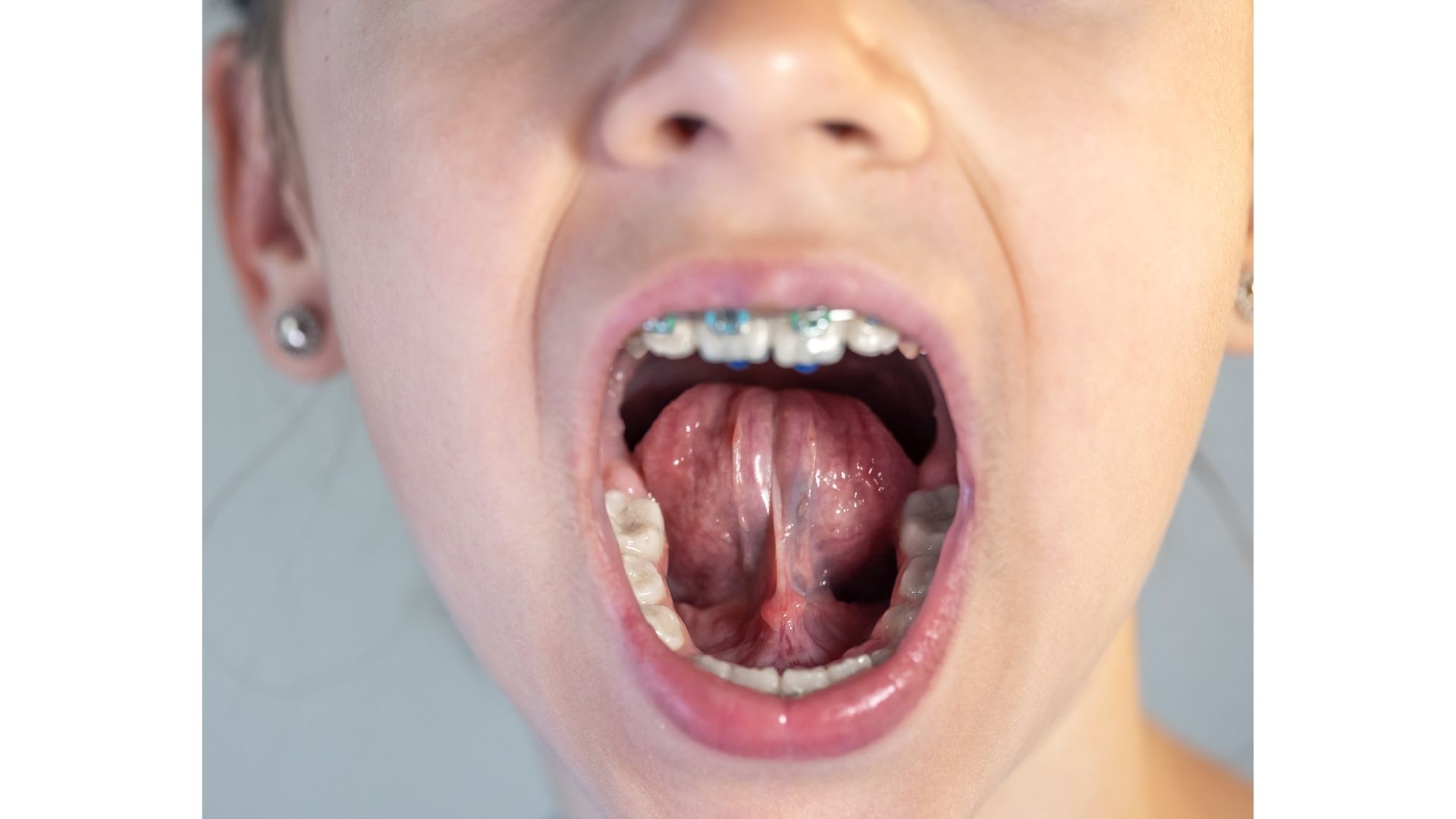 What is a frenectomy? What is a frenectomy?