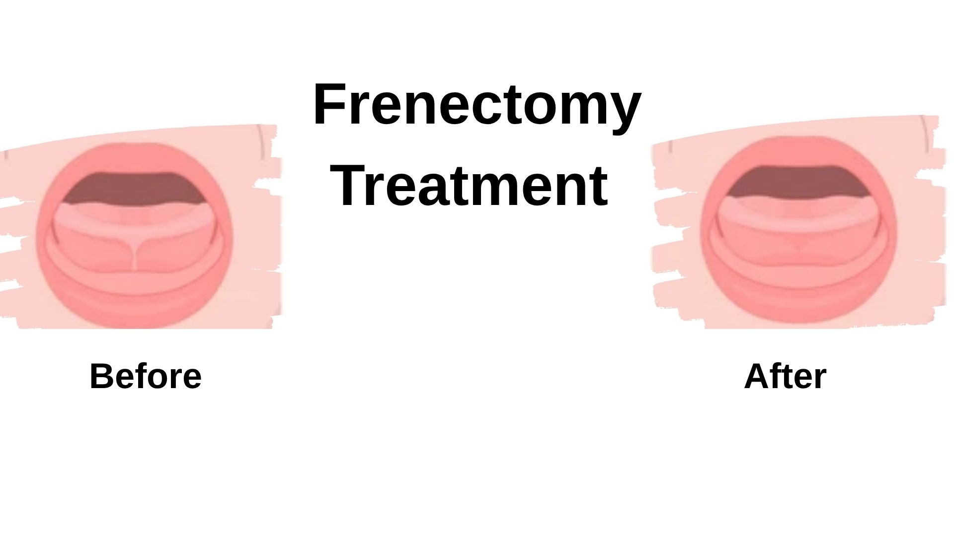 frenectomy-turkey-istanbul
