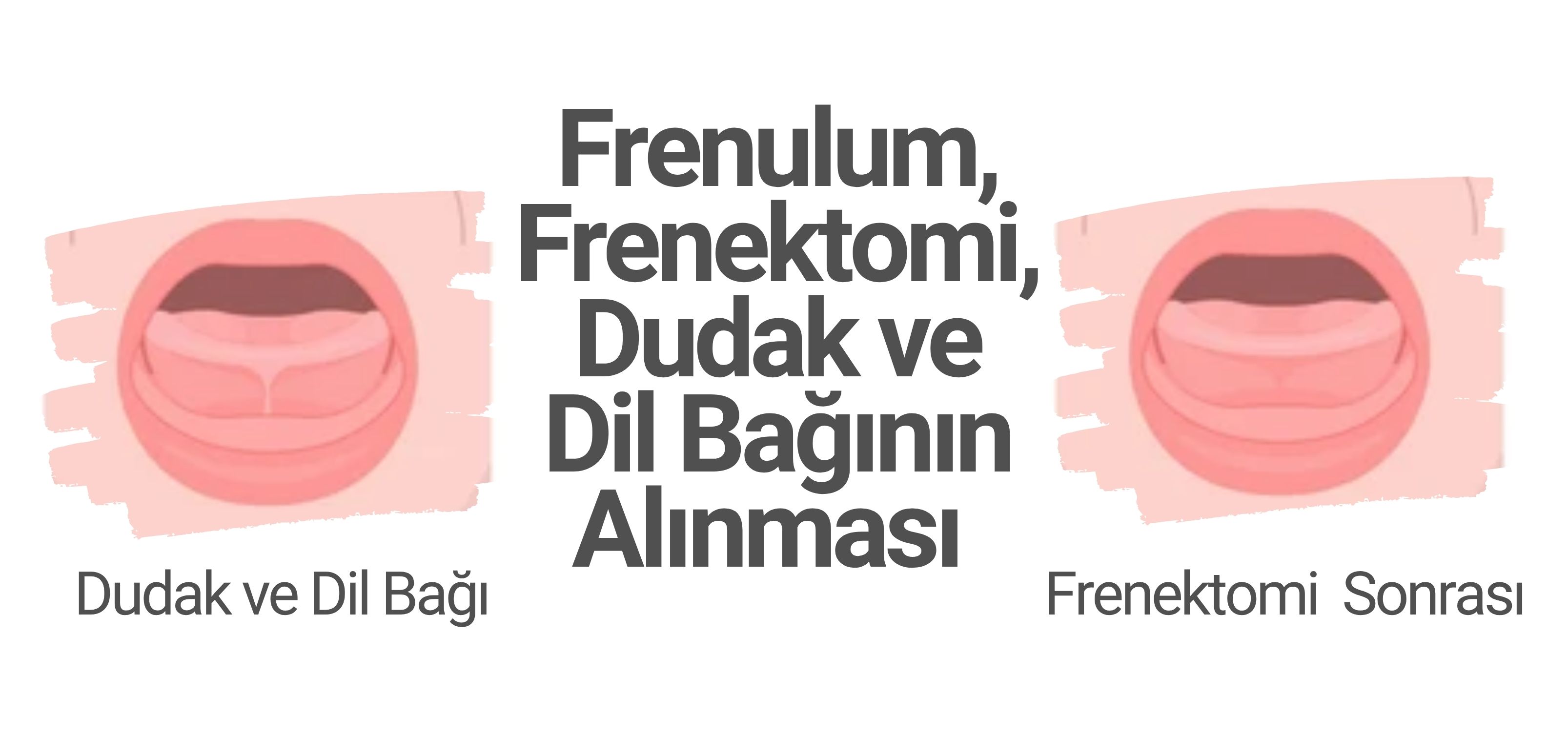 Frenulum, Frenektomi, Dudak ve Dil Bağının Alınması