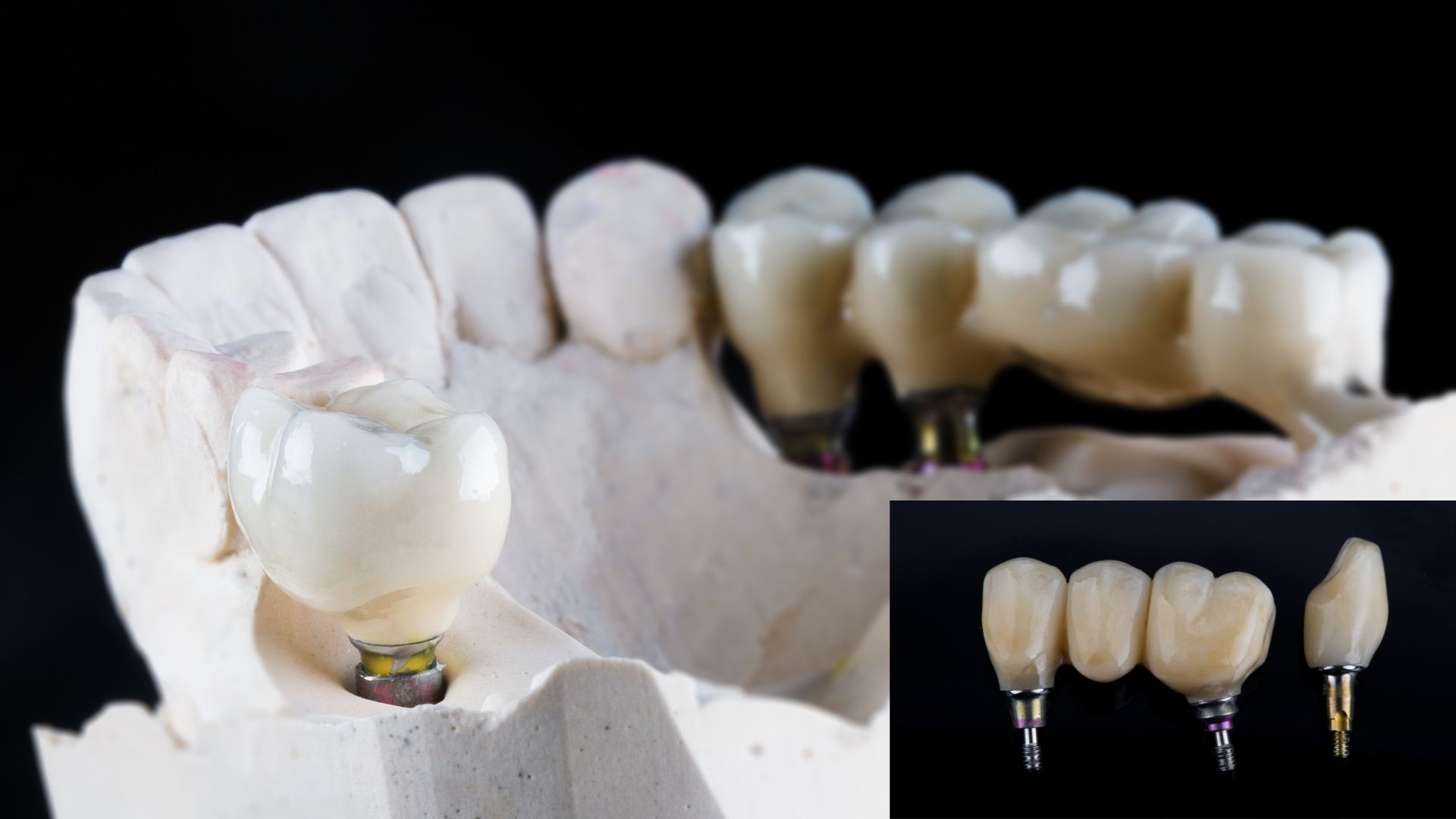 Implant-supported dental bridges Implant-supported dental bridges