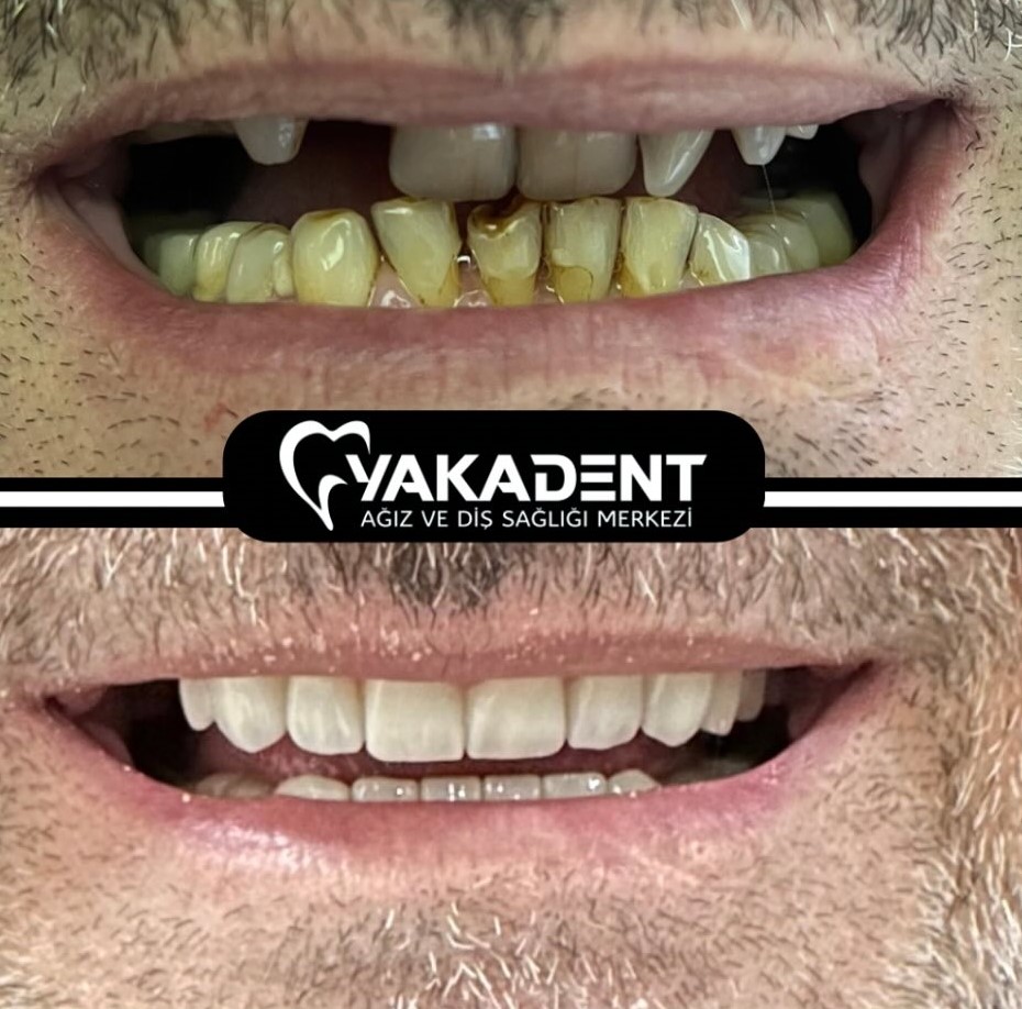 Advantages of dental implants Advantages of dental implants