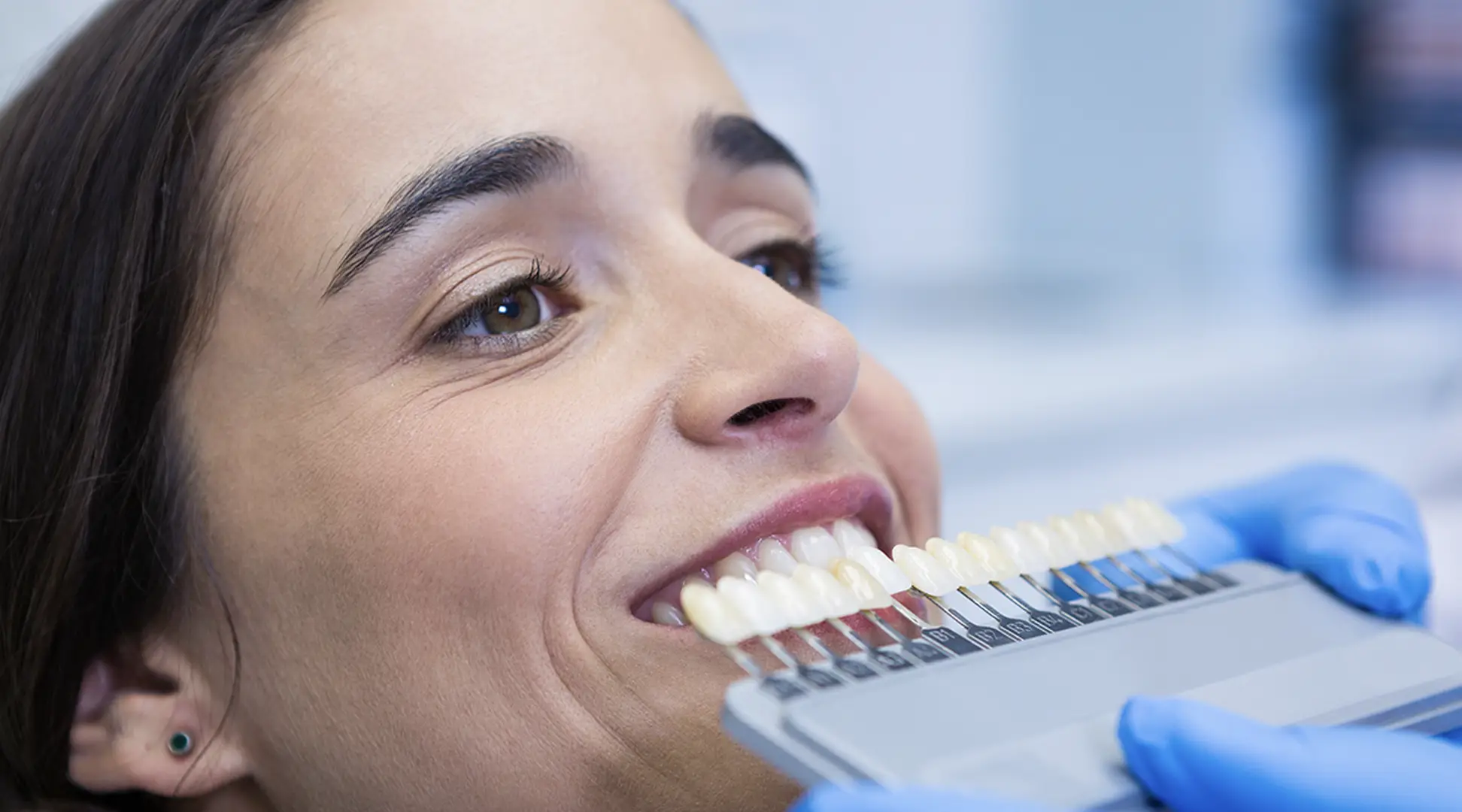 laminate-veneers