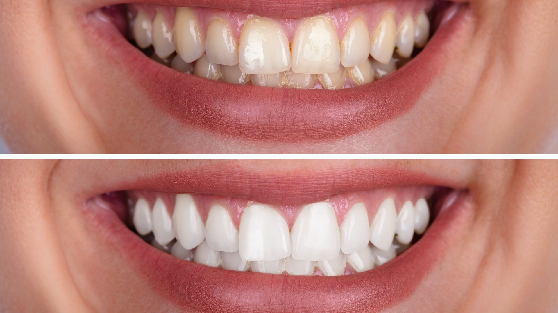 laser-teeth-whitening-before-after-1