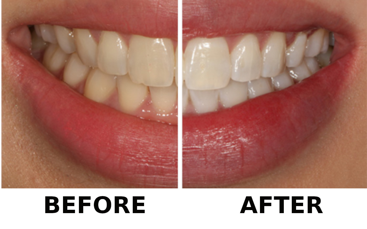 laser-teeth-whitening-before-after-2