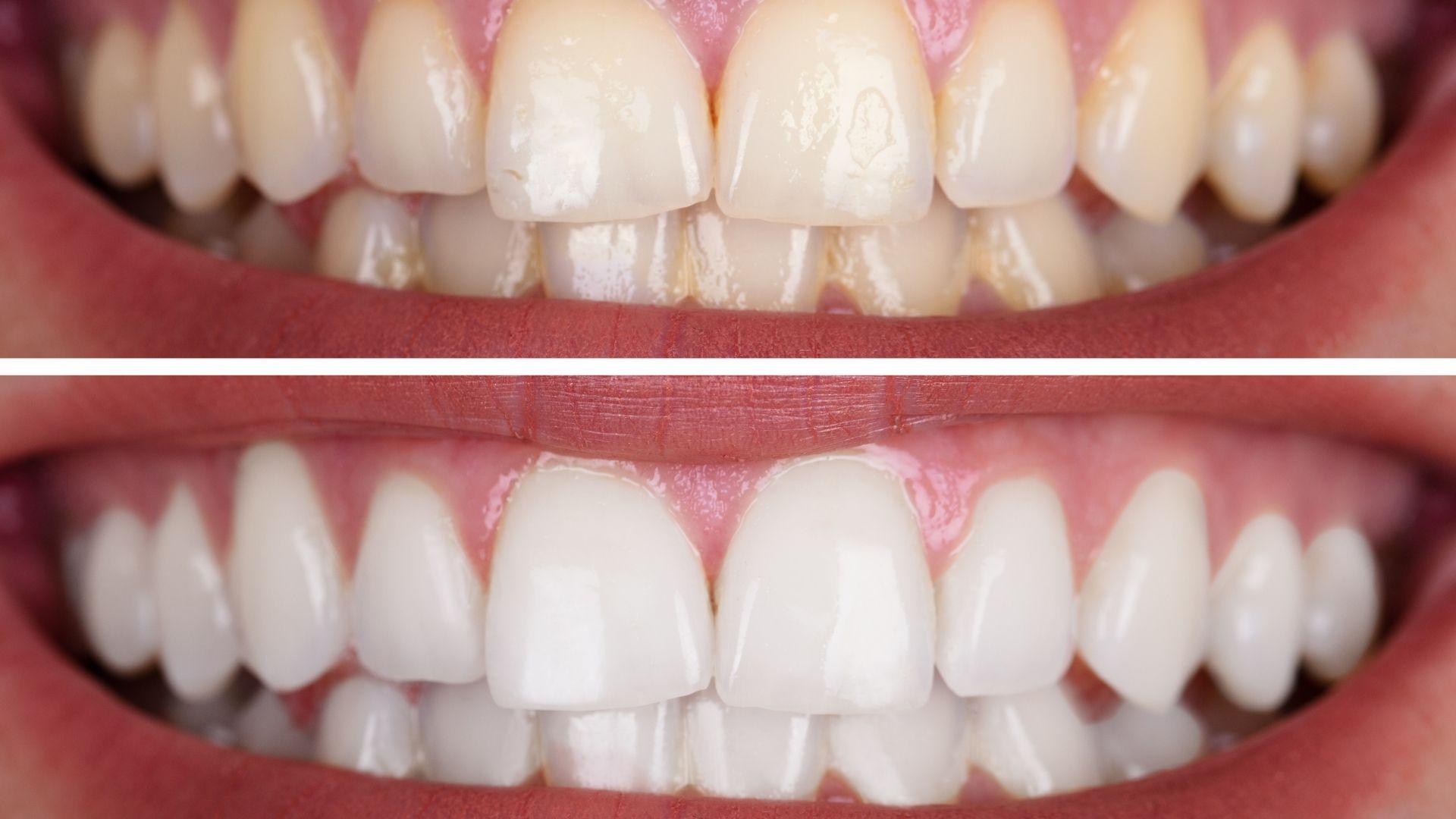 laser-teeth-whitening-before-after-4
