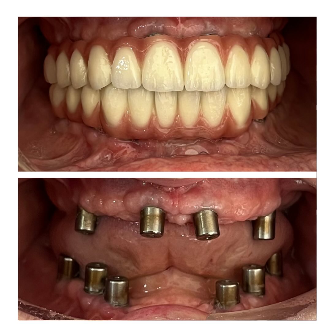 turkey-teeth-before-after-1 turkey-teeth-before-after-1
