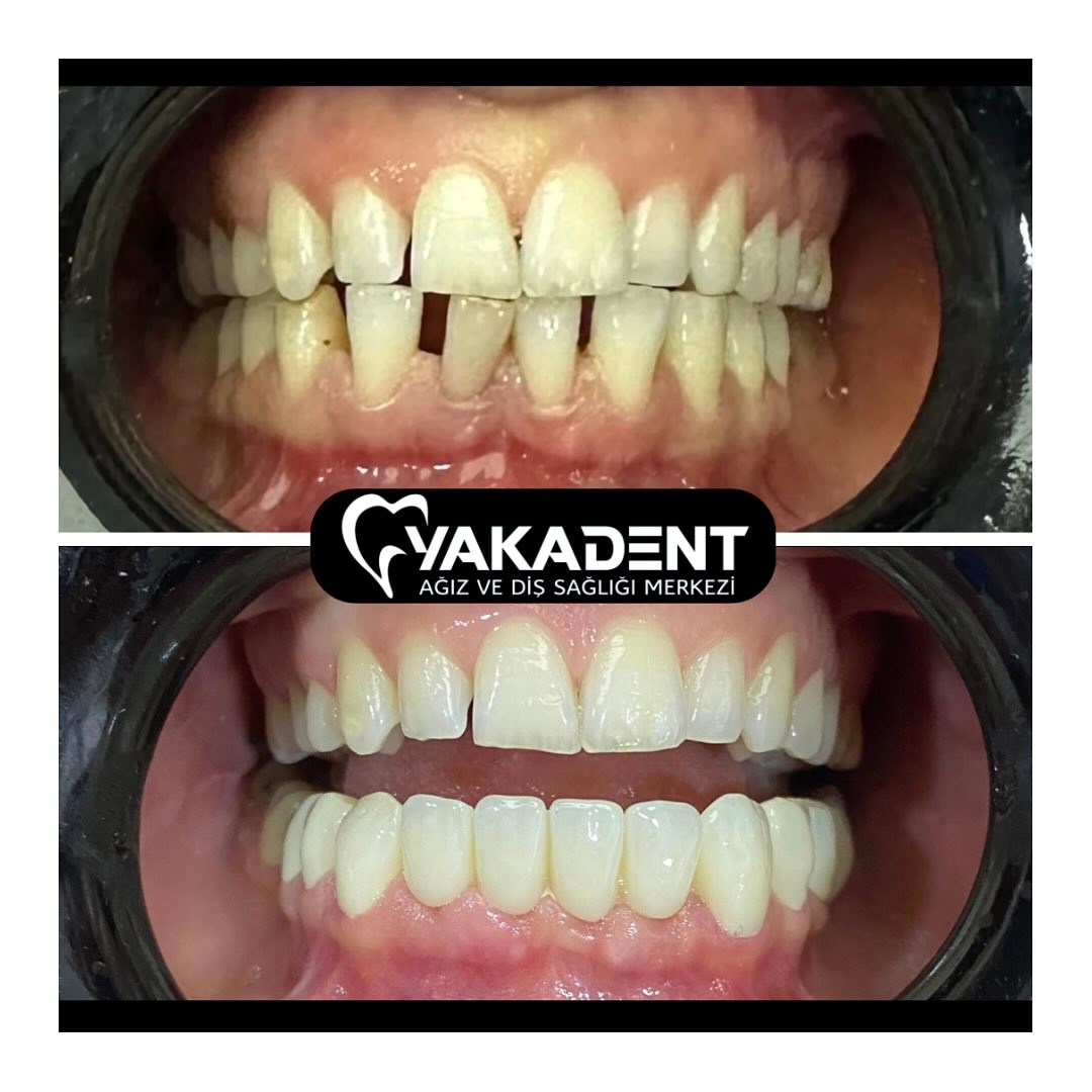 turkey-teeth-before-after-3 turkey-teeth-before-after-3
