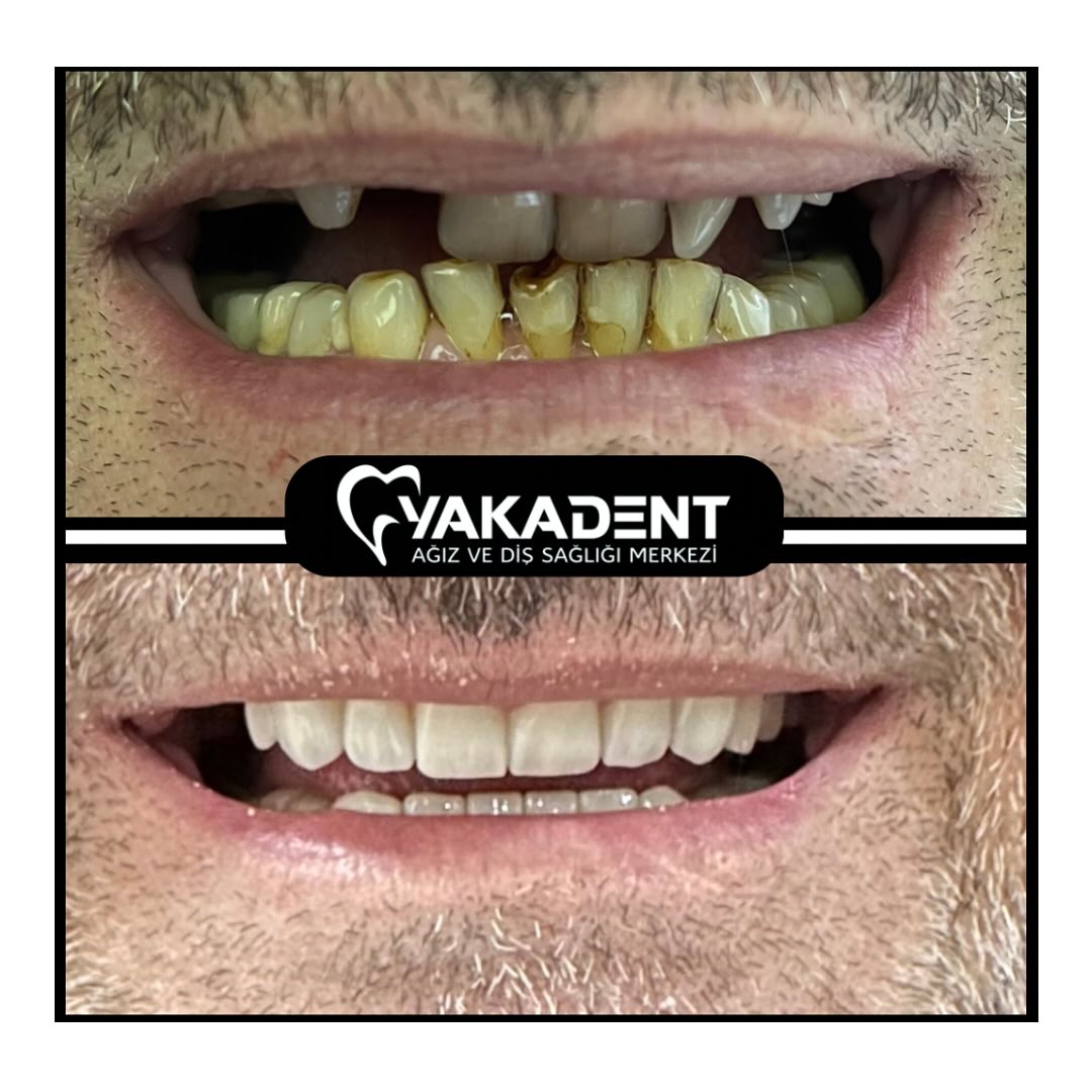 turkey-teeth-before-after-4 turkey-teeth-before-after-4
