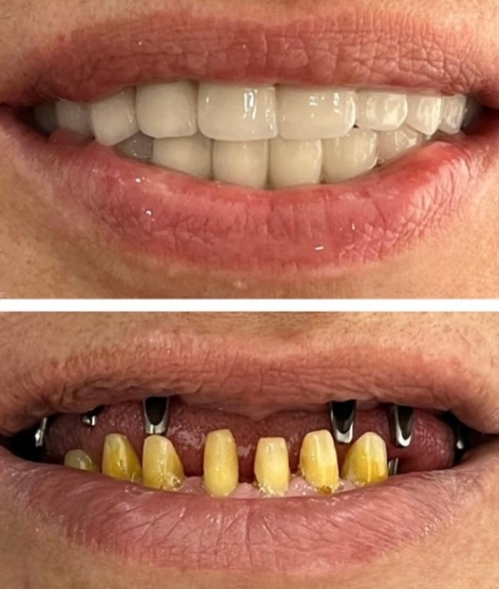 zirconium-crown-turkey-istanbul zirconium-crown-turkey-istanbul