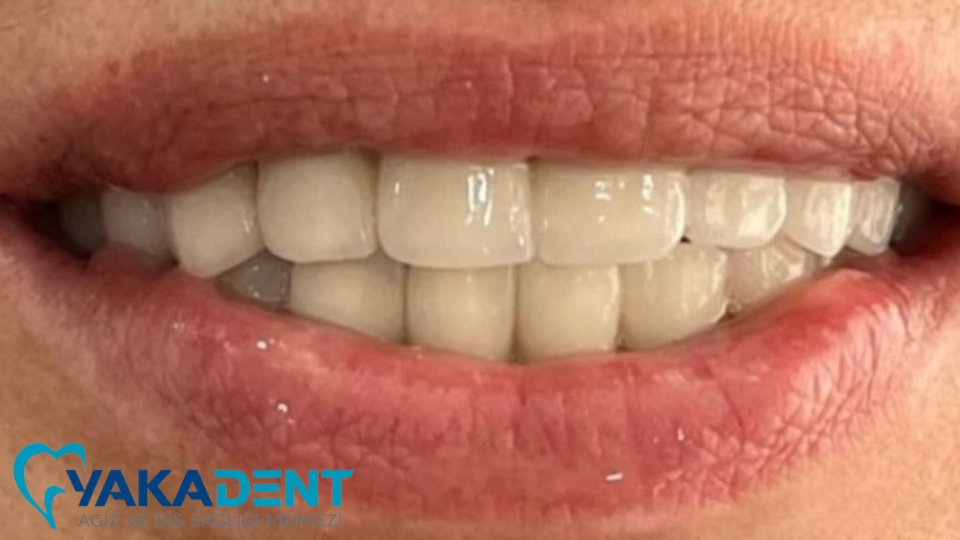 Are zirconium veneers worth it? Are zirconium veneers worth it?